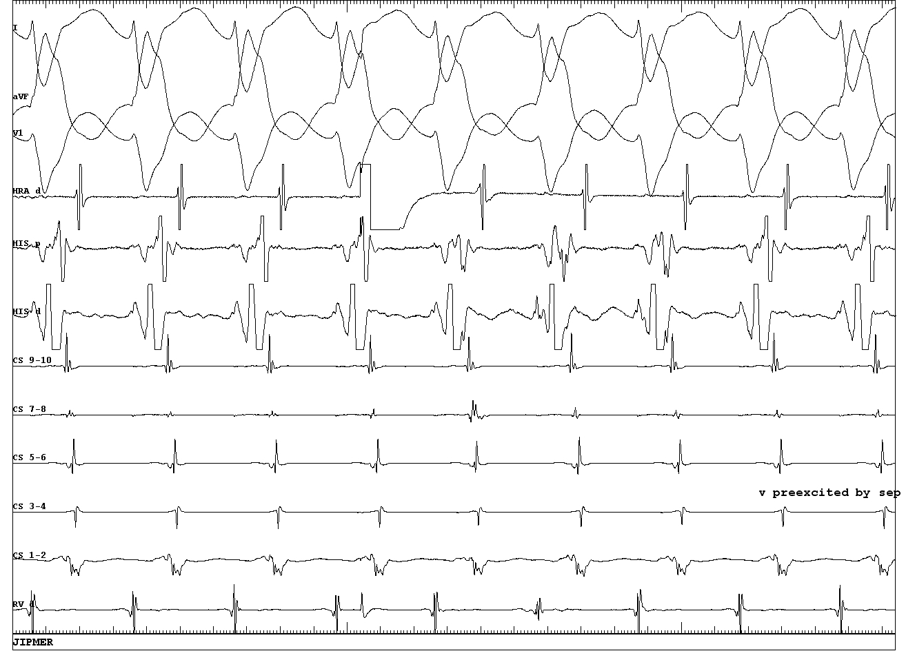 05_septal ref PAC.JPG